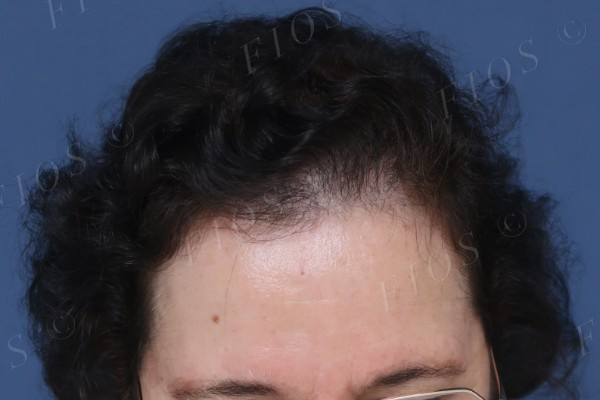 Antes do transplante capilar