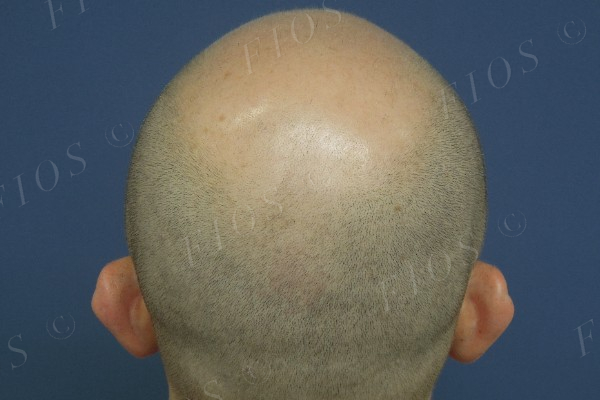 Depois do transplante capilar
