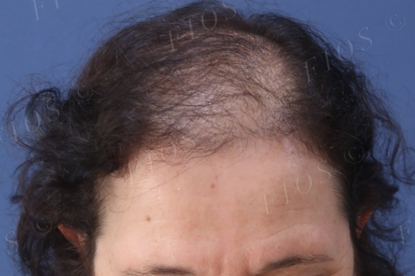 Depois do transplante capilar