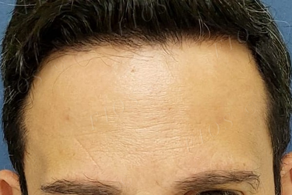 Antes do transplante capilar