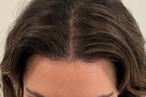 Antes do transplante capilar