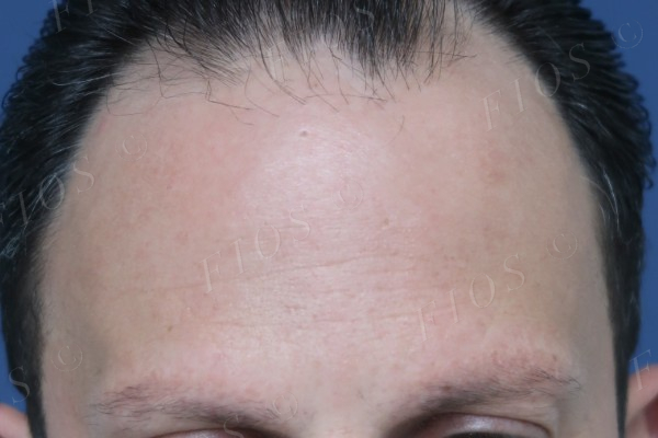 Depois do transplante capilar