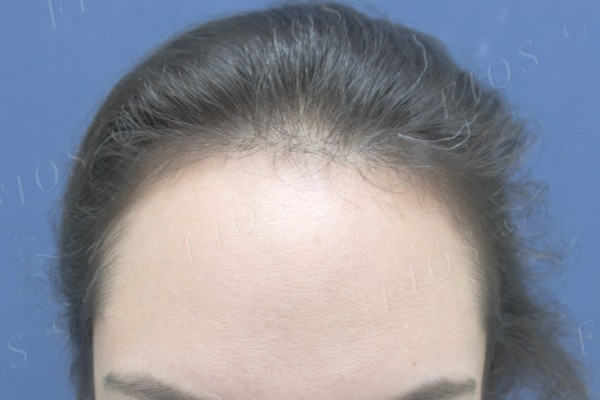 Depois do transplante capilar